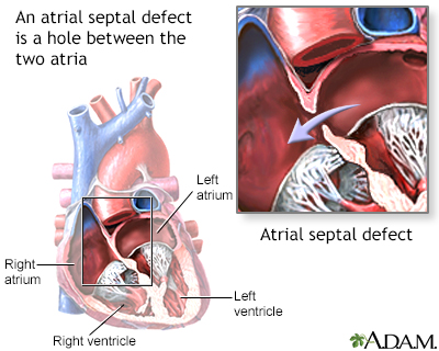 Atrial septal defect Atrial septal defect