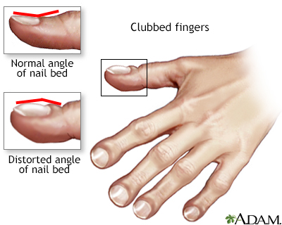 Clubbed fingers Clubbed fingers