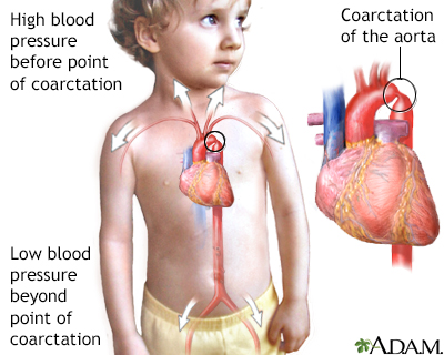 Coarctation of the aorta Coarctation of the aorta