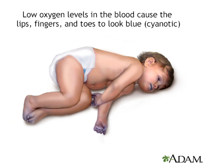 Cyanotic heart disease Cyanotic heart disease