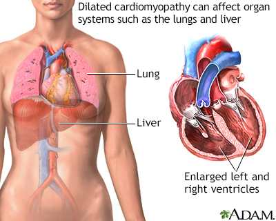Dilated cardiomyopathy Dilated cardiomyopathy