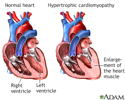 Hypertrophic cardiomyopathy Hypertrophic cardiomyopathy