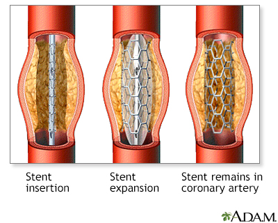 Coronary artery stent Coronary artery stent