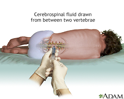 Lumbar puncture - spinal tap Lumbar puncture - spinal tap