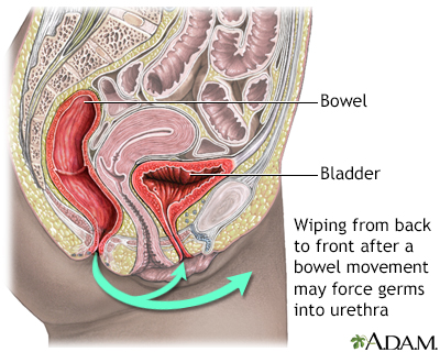 Prevention of cystitis Prevention of cystitis