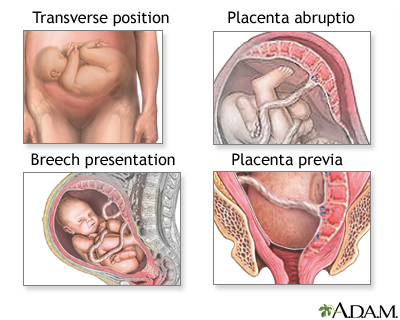C-Section C-Section