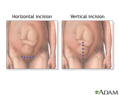 C-Section C-Section