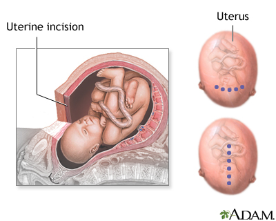 C-Section Uterine Incision 5 C-Section Uterine Incision 5