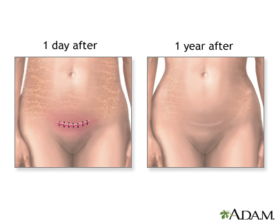 C-Section C-Section