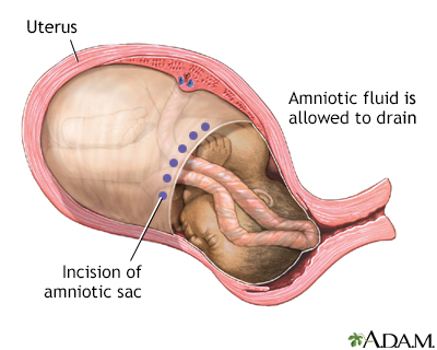 C-Section C-Section