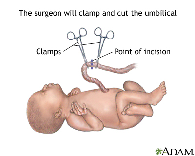 C-Section C-Section