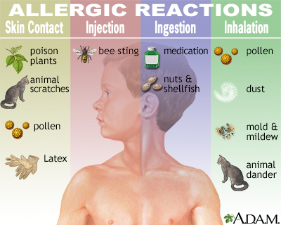 Allergic reactions Allergic reactions
