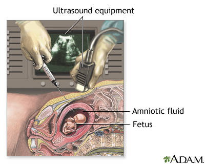 Amniocentesis Amniocentesis