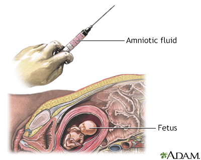 Amniocentesis Amniocentesis