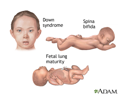 Amniocentesis Amniocentesis