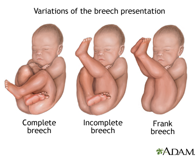 Breech Presentation Breech Presentation