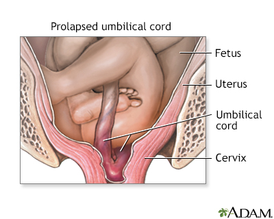 Prolapsed Umbilical Cord Prolapsed Umbilical Cord