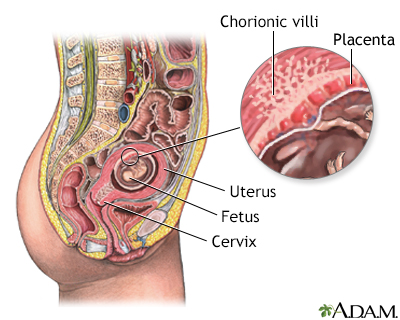 Chorionic Villus Sampling Chorionic Villus Sampling