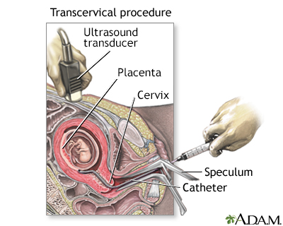 Chorionic Villus Sampling Chorionic Villus Sampling