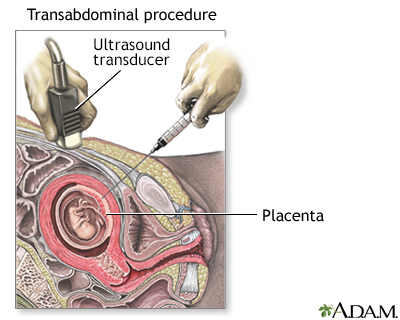 Chorionic Villus Sampling Chorionic Villus Sampling