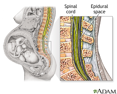 Procedure - Epidural 1 Procedure - Epidural 1