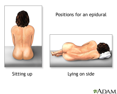 Procedure - Epidural 2 Procedure - Epidural 2