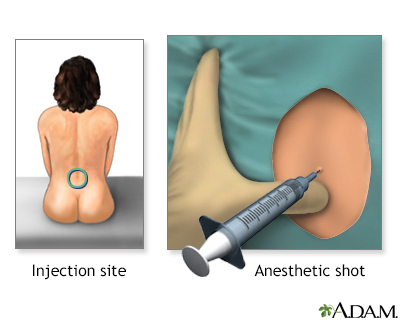 Procedure - Epidural 3 Procedure - Epidural 3