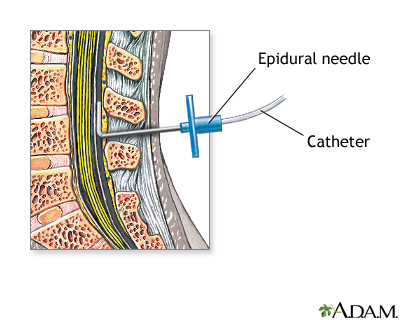 Procedure - Epidural 4 Procedure - Epidural 4