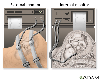 Procedure - Epidural 5 Procedure - Epidural 5