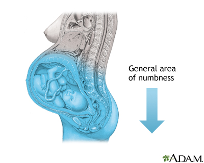 Procedure - Epidural 6 Procedure - Epidural 6