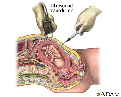 Percutaneous Umbilical Cord Sampling 2 Percutaneous Umbilical Cord Sampling 2