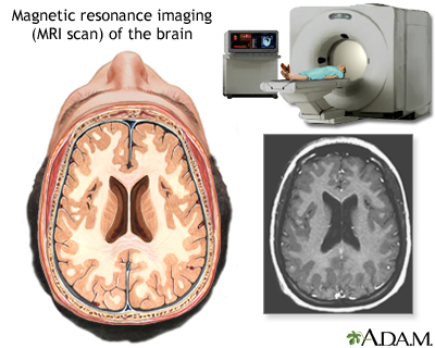 MRI of the brain MRI of the brain
