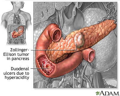 Cause of peptic ulcers Cause of peptic ulcers