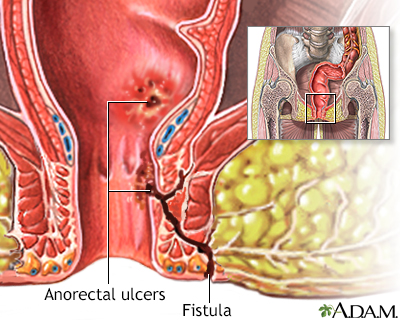 Anorectal fistulas Anorectal fistulas