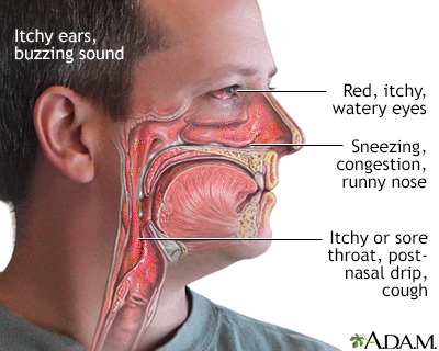 Allergy symptoms Allergy symptoms