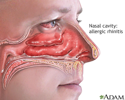 Allergic rhinitis Allergic rhinitis