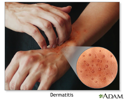 Atopic dermatitis Atopic dermatitis