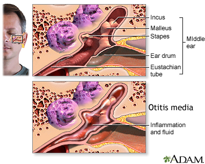 Middle ear infection (otitis media) Middle ear infection (otitis media)