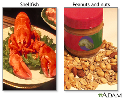 Food allergies Food allergies