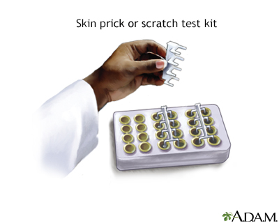 Allergy skin prick or scratch test Allergy skin prick or scratch test