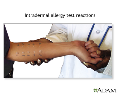 Intradermal allergy test reactions Intradermal allergy test reactions
