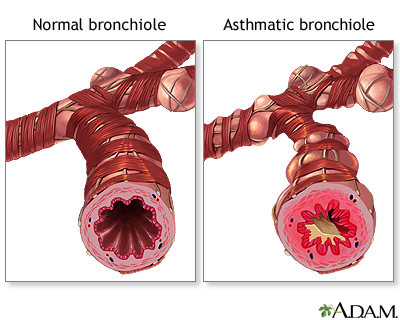 Normal versus asthmatic bronchiole Normal versus asthmatic bronchiole
