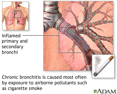 Cause of chronic bronchitis Cause of chronic bronchitis