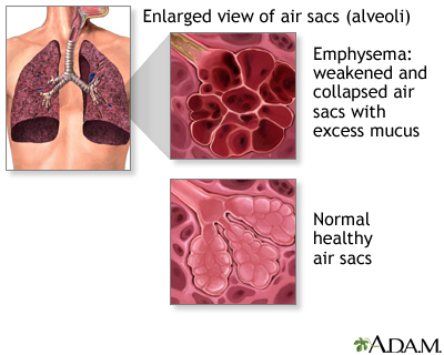 COPD (chronic obstructive pulmonary disorder) COPD (chronic obstructive pulmonary disorder)