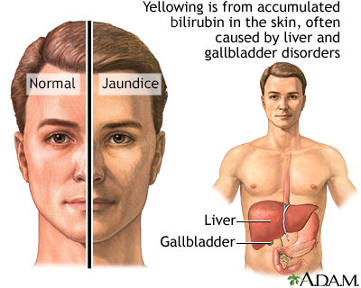 Jaundice Jaundice