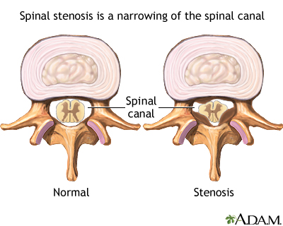 Spinal stenosis Spinal stenosis