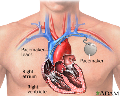 Pacemaker Pacemaker