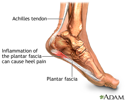 Plantar fasciitis Plantar fasciitis