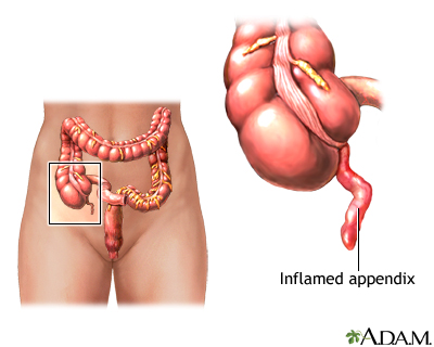 Appendicitis Appendicitis
