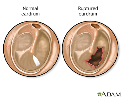 Ruptured eardrum Ruptured eardrum